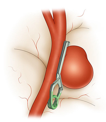 脳動脈瘤に対するコイリング術 | 脳血管内治療学研究センター｜順天堂大学
